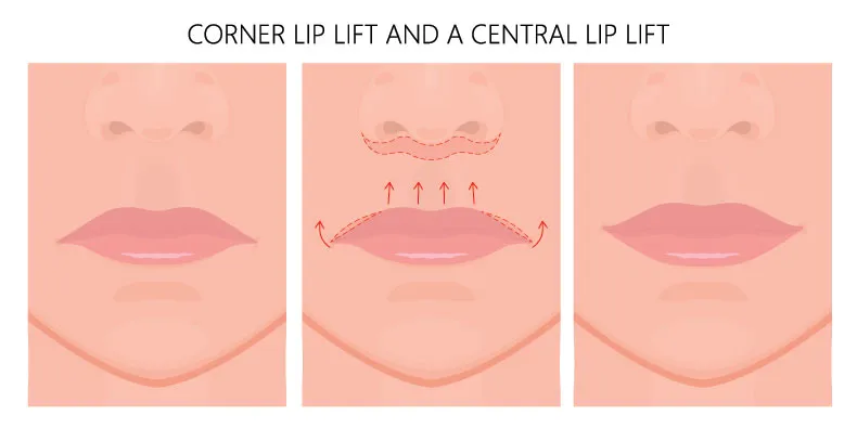 Lift lip illustration
