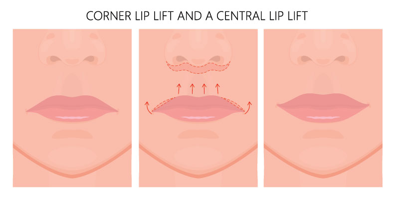Lift lip illustration