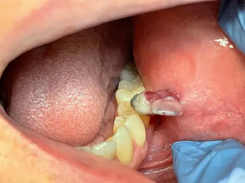 photo showing oral cancer