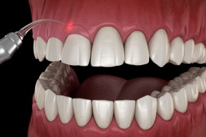 illustration of crown lengthening
