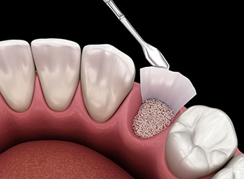 socket preservation illustration