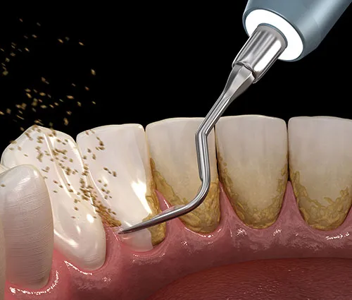 Illustration of teeth cleaning