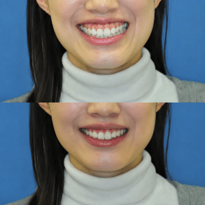 before and after
